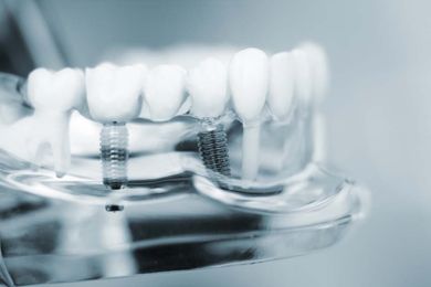 Implantat Zahn